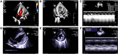 Interplay between mitochondrial dysfunction and lysosomal storage: challenges in genetic metabolic muscle diseases with a focus on infantile onset Pompe disease